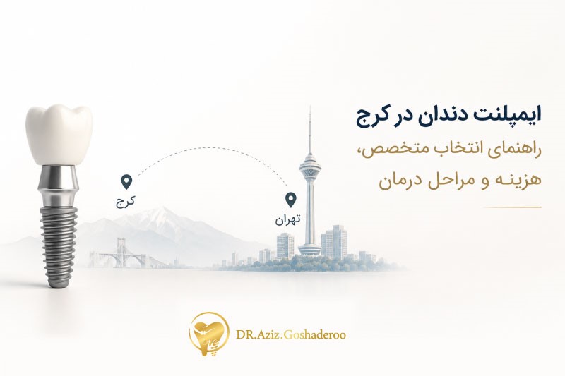 ایمپلنت دندان در کرج